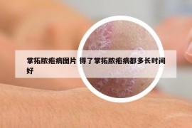 掌拓脓疱病图片 得了掌拓脓疱病都多长时间好