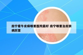 南宁看牛皮癣哪里医院最好 南宁哪里治皮肤病厉害