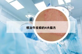 根治牛皮癣的4大偏方