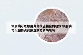 银屑病可以服用贞芪扶正颗粒的功效 银屑病可以服用贞芪扶正颗粒的功效吗