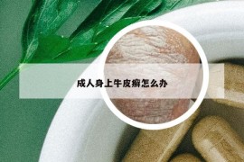 成人身上牛皮癣怎么办
