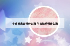 牛皮癣患者喝什么汤 牛皮肤癣喝什么汤