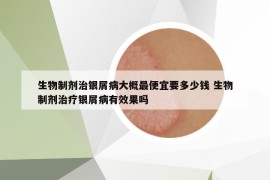 生物制剂治银屑病大概最便宜要多少钱 生物制剂治疗银屑病有效果吗