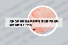 淀粉性皮肤样变是银屑病吗 淀粉性样变皮肤病会遗传给下一代吗