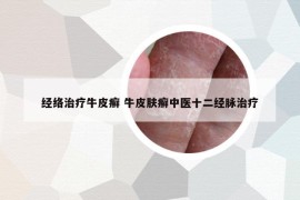 经络治疗牛皮癣 牛皮肤癣中医十二经脉治疗