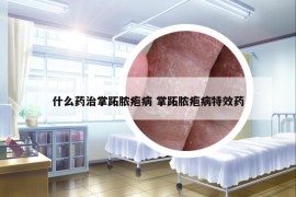 什么药治掌跖脓疱病 掌跖脓疱病特效药