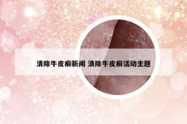 清除牛皮癣新闻 清除牛皮癣活动主题