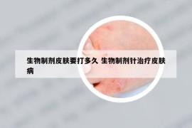 生物制剂皮肤要打多久 生物制剂针治疗皮肤病