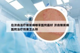 在济南治疗银屑病哪家医院最好 济南银屑病医院治疗效果怎么样