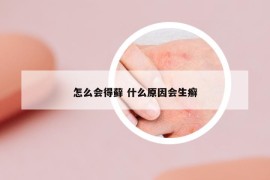 怎么会得藓 什么原因会生癣