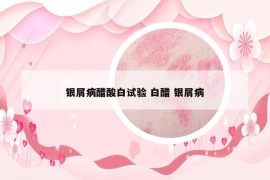 银屑病醋酸白试验 白醋 银屑病