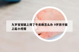 九岁宝宝腿上得了牛皮癣怎么办 9岁孩子腿上起小疙瘩