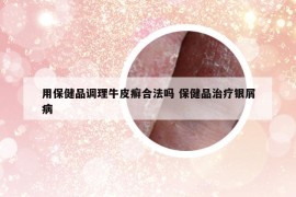 用保健品调理牛皮癣合法吗 保健品治疗银屑病