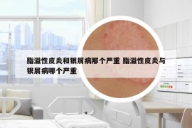 脂溢性皮炎和银屑病那个严重 脂溢性皮炎与银屑病哪个严重