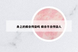 身上的癣会传染吗 癣会不会传染人