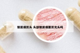 银屑病剪头 头部银屑病要剪光头吗