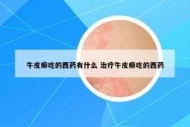 牛皮癣吃的西药有什么 治疗牛皮癣吃的西药