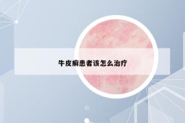 牛皮癣患者该怎么治疗