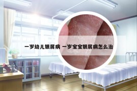 一岁幼儿银屑病 一岁宝宝银屑病怎么治