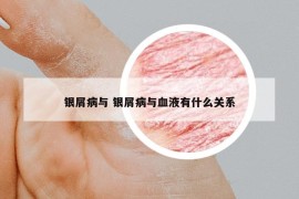 银屑病与 银屑病与血液有什么关系