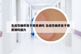 急痘性糠疹属于银屑病吗 急痘性糠疹属于银屑病吗图片