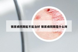银屑病初期能不能治好 银屑病初期是什么样