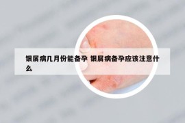 银屑病几月份能备孕 银屑病备孕应该注意什么