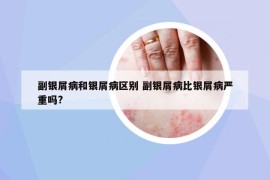 副银屑病和银屑病区别 副银屑病比银屑病严重吗?
