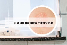 肝肾阴虚加重银屑病 严重肝肾阴虚