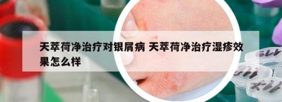 天萃荷净治疗对银屑病 天萃荷净治疗湿疹效果怎么样