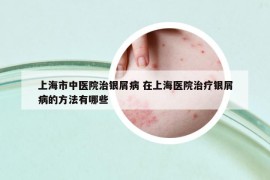 上海市中医院治银屑病 在上海医院治疗银屑病的方法有哪些