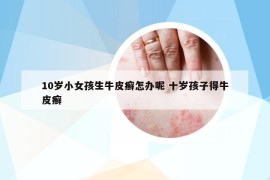 10岁小女孩生牛皮癣怎办呢 十岁孩子得牛皮癣