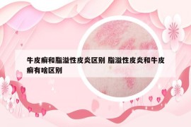 牛皮癣和脂溢性皮炎区别 脂溢性皮炎和牛皮癣有啥区别