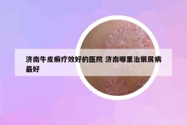 济南牛皮癣疗效好的医院 济南哪里治银屑病最好