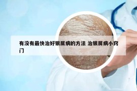 有没有最快治好银屑病的方法 治银屑病小窍门