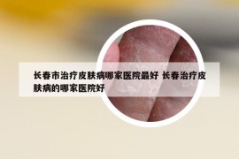 长春市治疗皮肤病哪家医院最好 长春治疗皮肤病的哪家医院好