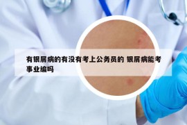 有银屑病的有没有考上公务员的 银屑病能考事业编吗