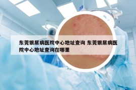 东莞银屑病医院中心地址查询 东莞银屑病医院中心地址查询在哪里