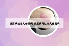 银屑病能吃人参果吗 银屑病可以吃人参果吗