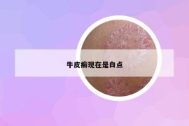 牛皮癣现在是白点