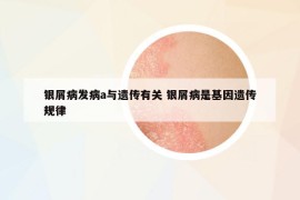 银屑病发病a与遗传有关 银屑病是基因遗传规律