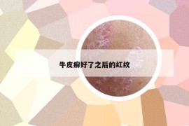 牛皮癣好了之后的红纹