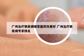 广州治疗银屑病哪家医院效果好 广州治疗银屑病专家排名