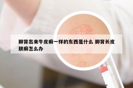 脚背出来牛皮癣一样的东西是什么 脚背长皮肤癣怎么办