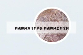 白点癫风涂什么药膏 白点癫风怎么控制