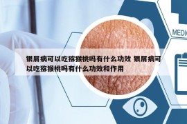 银屑病可以吃猕猴桃吗有什么功效 银屑病可以吃猕猴桃吗有什么功效和作用