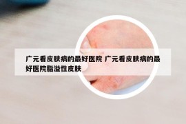 广元看皮肤病的最好医院 广元看皮肤病的最好医院脂溢性皮肤