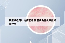 银屑病吃可以吃桑葚吗 银屑病为什么不能喝桑叶水
