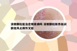 消银颗粒能治愈银屑病吗 消银颗粒除养血润肤祛风止痒外又能