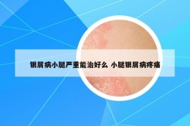 银屑病小腿严重能治好么 小腿银屑病疼痛